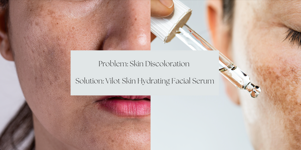 5 Types of Skin Discoloration & How to Treat Them