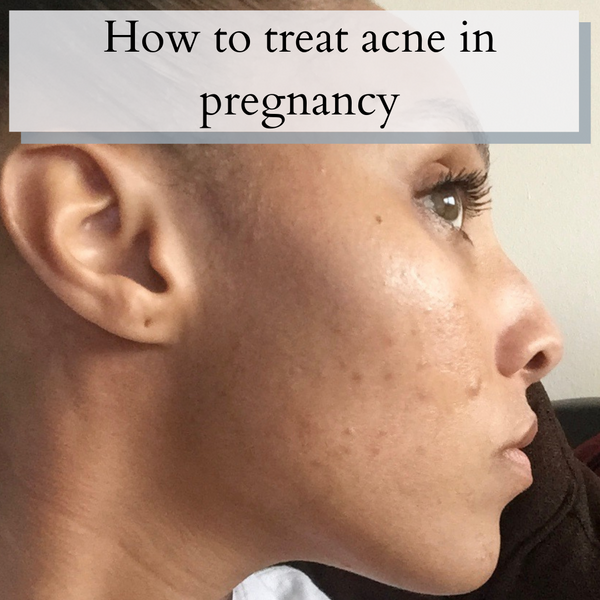 How to Treat Pregnancy Acne